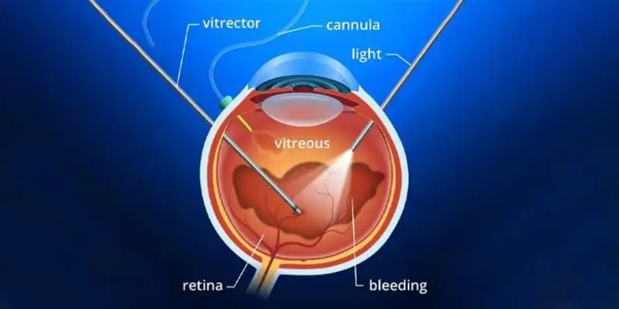 Home dr ashwini karanjgaokar an ophthalmologist and eye surgeon complex vitreo retinal